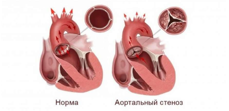 Аортальный стеноз