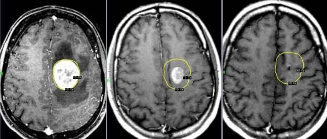 На снимке опухоль головного мозга 